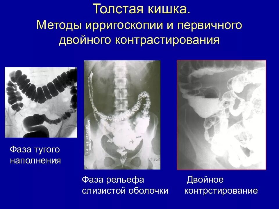 Ирригоскопия с двойным контрастированием. Ирригоскопия толстого кишечника рентген. контрастирование толстого кишечника рентген. ирригоскопия фаза тугого наполнения. травмы толстого кишечника рентген.