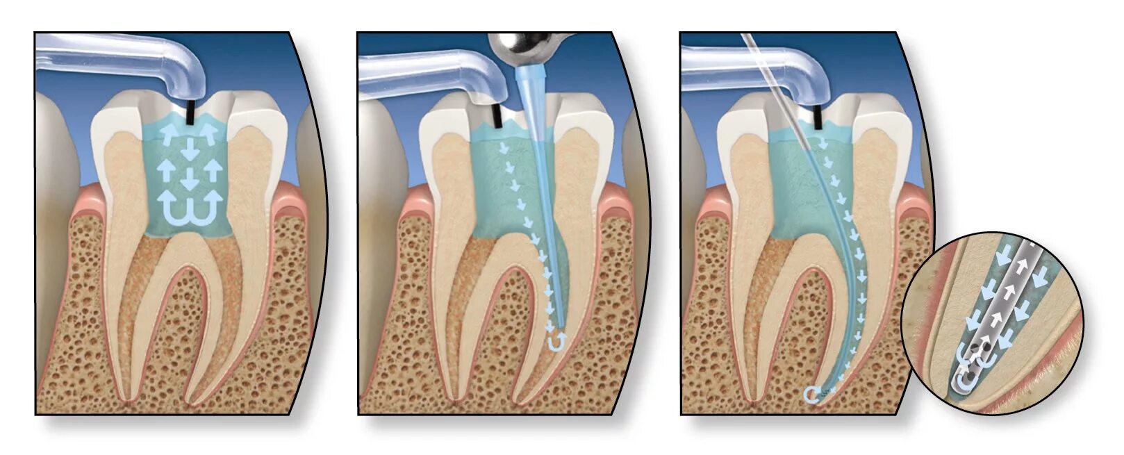 Восстановление после эндодонтического лечения. Пульпита (депульпирование зуба. Что такое периодонтит в стоматологии. Периодонтит 1 канальный. Апикальный периодонтит.
