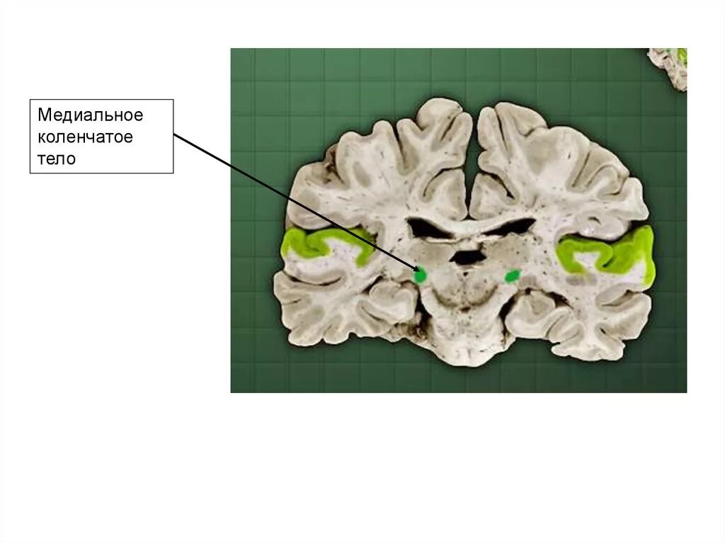 Коленчатые тела мозга. Медиальное коленчатое тело. Наружные коленчатые тела. Мед коленчатые тела. Коленчатые тела таламуса.