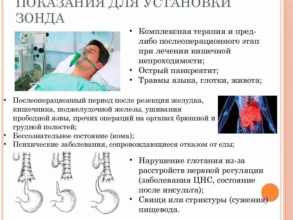 Назогастральный зонд. Зонд Нозо.. Желудочный зонд назогастральный. Установка желудочного зонда.