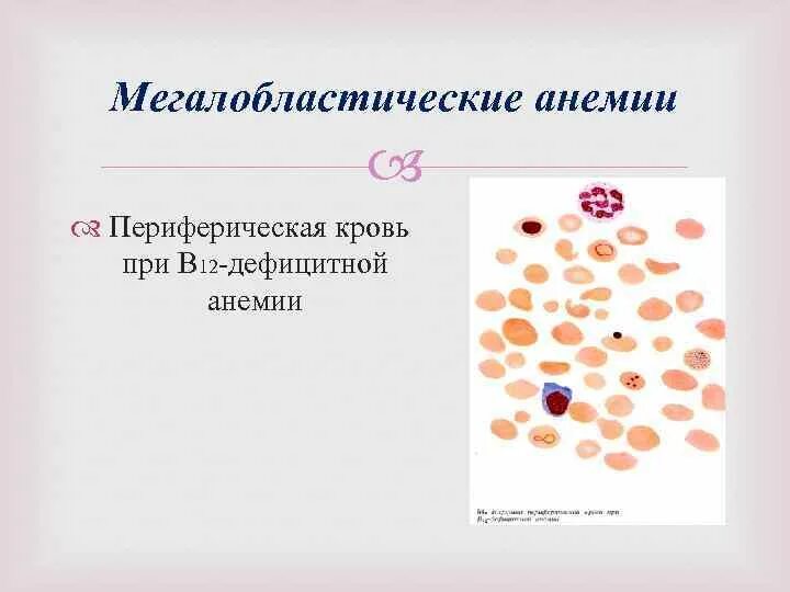Для в12 дефицитной анемии характерно наличие. Периферическая кровь при мегалобластной анемии. мегалобластический тип кроветворения характерен для. мегалобластический тип анемии.