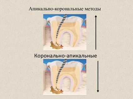 Апикальный упор