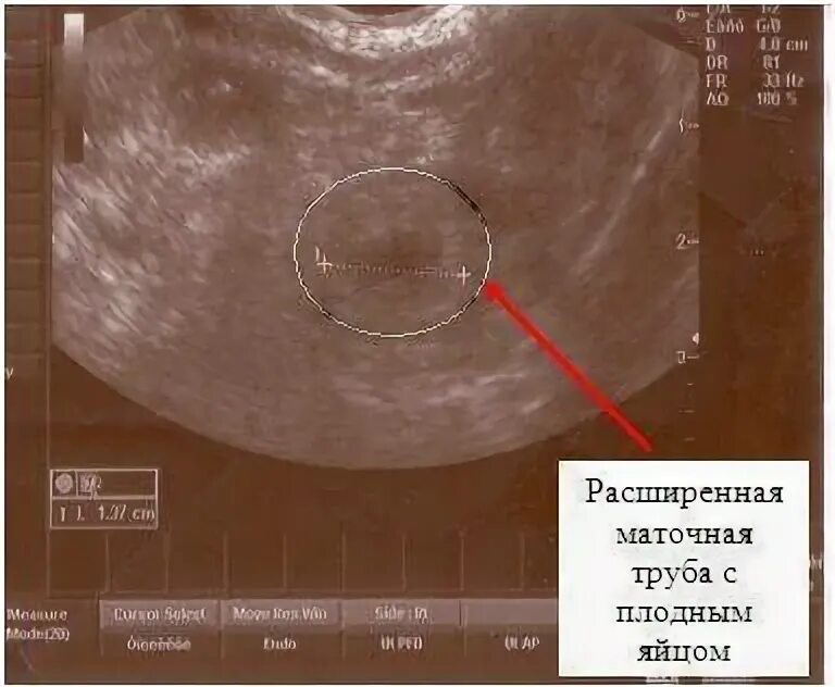 Эмбрион в матке после зачатия