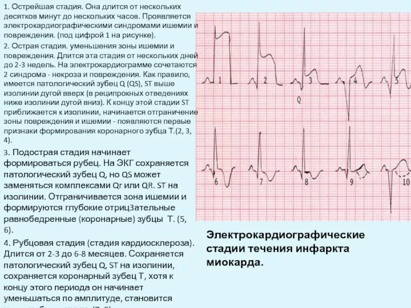 St ишемия. Постинфарктный кардиосклероз на ЭКГ. Стадия 1 при инфаркте миокарда на ЭКГ. ЭКГ инфаркт миокарда с подъемом St переднеперегородочный. ЭКГ критерии инфаркта миокарда с подъемом St.