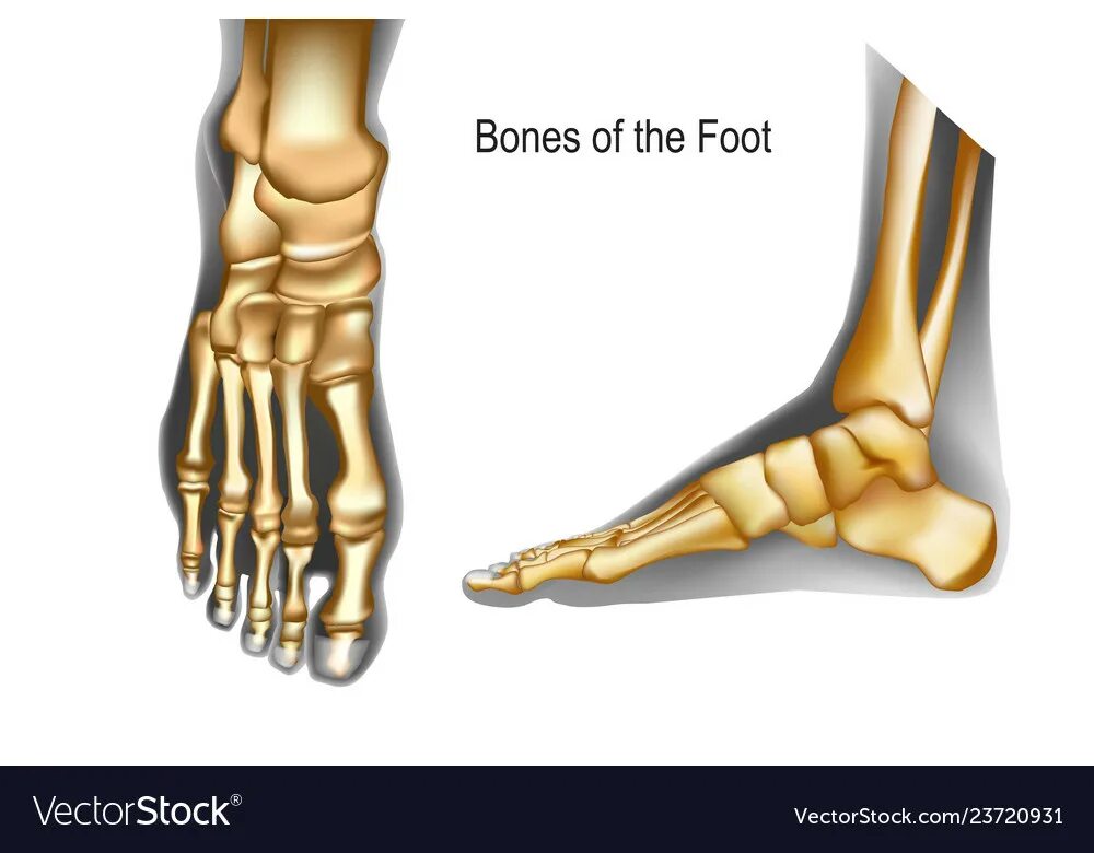Кости стопы плакат. Рассосалась кость стопы.