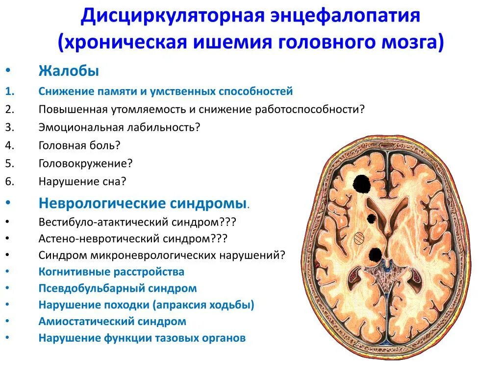 Дисциркуляторная энцефалопатия головного мозга. Признаки дисциркуляторной энцефалопатии. Энцефалопатия клинические проявления. Хроническая дисциркуляторная энцефалопатия симптомы.