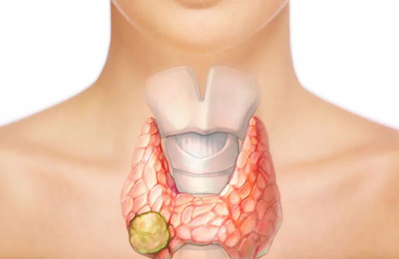 Что такое щитовидная железа. Тироид для щитовидной железы. Щитовидка железа щитовидная. Щитовидная железа зоб узлы.