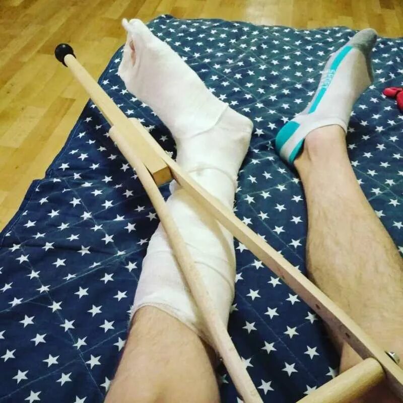 Наложение гипса при переломе лодыжки. Гипс г5 самарский. Синий гипс. Алебастр русгипс 25 кг. Эластичный бинт на стопу.