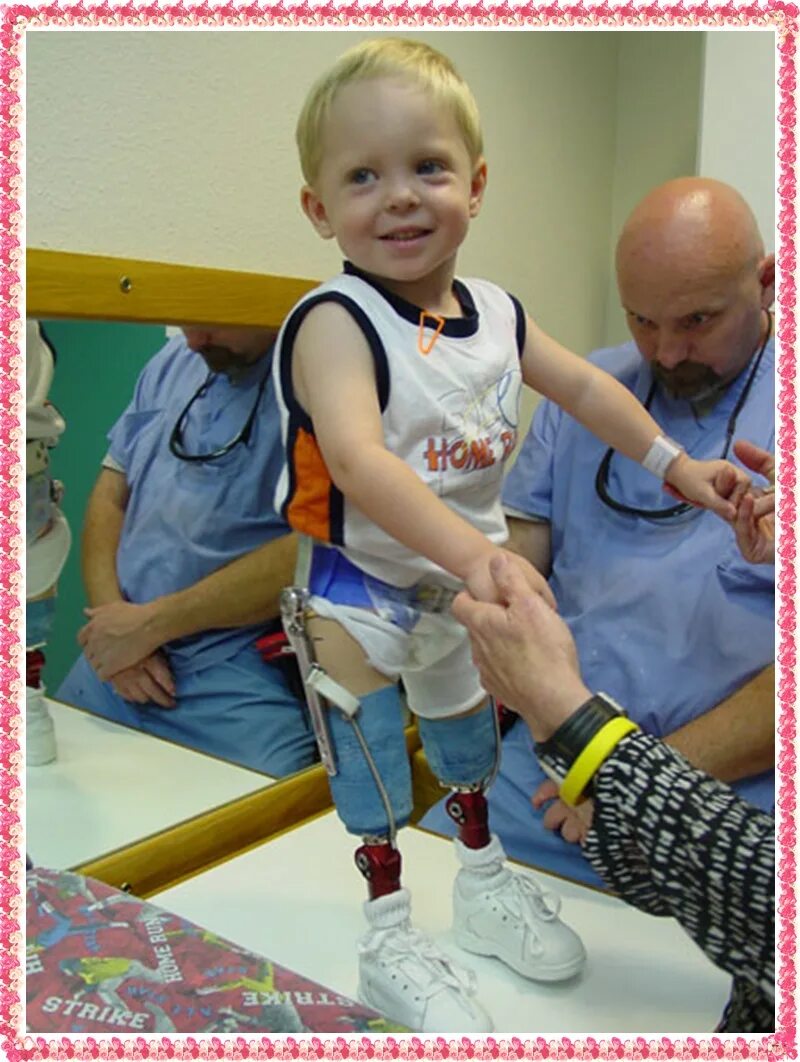 Родился без ноги. Родился без ноги. Дети без конечностей рук. Родился без ноги. Младенцы, рожденные без конечностей.