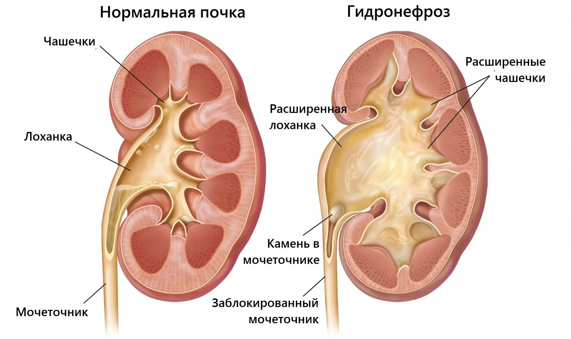 Кровь в лоханке почки. Врожденный гидронефроз почки. Строение почки гидронефроз анатомия. Расширена лоханка почки на кт. Расширение лоханки почки.