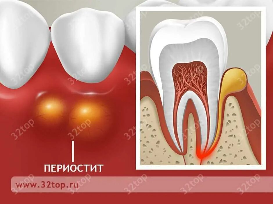 Как снять зубную опухоль