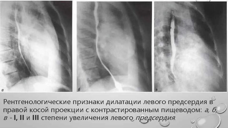 Признаки увеличения предсердий. Признаки дилатации левого предсердия. начальная дилатация лп. дементация левого предсердия. дилатация левого предсердия причины.