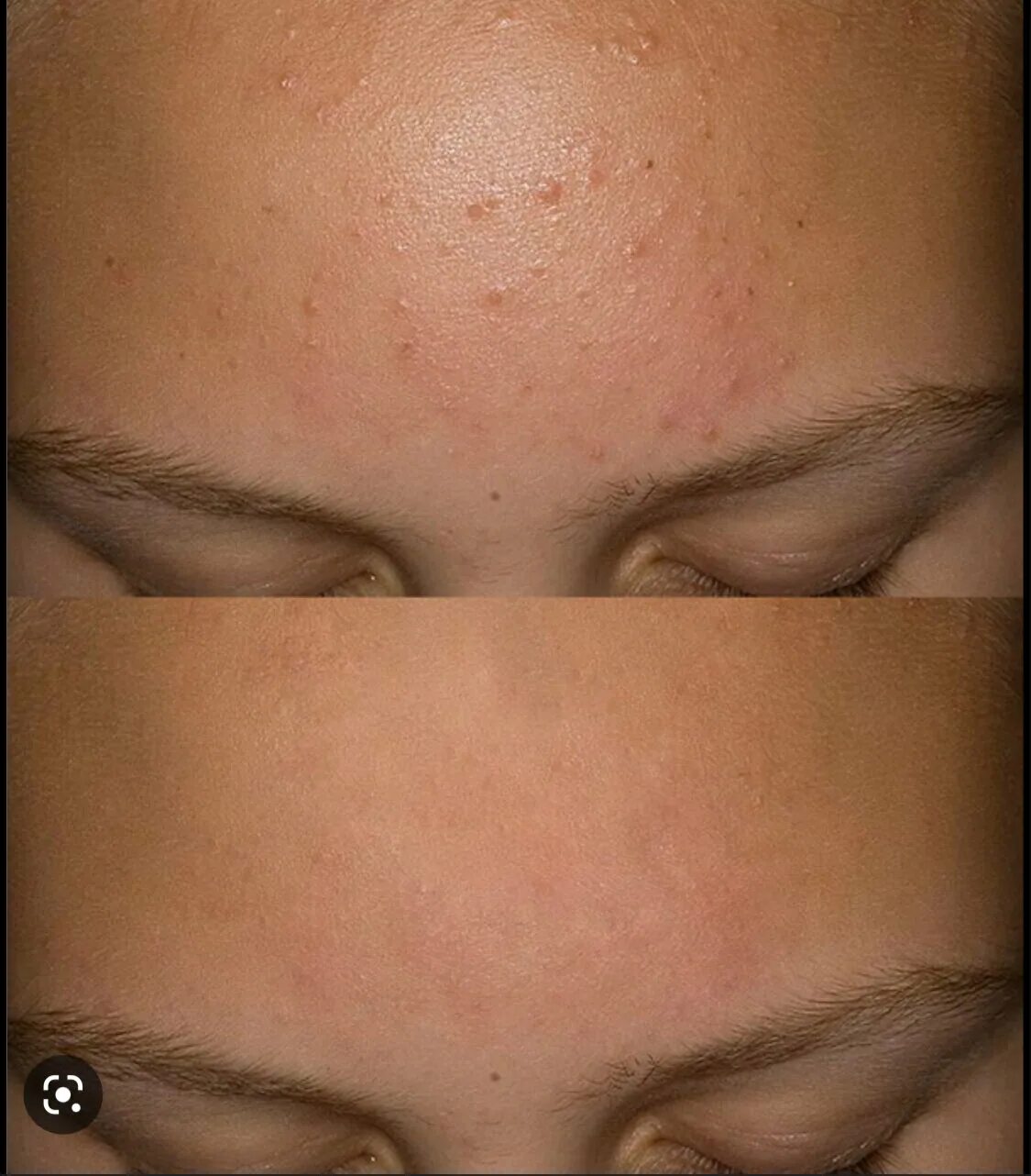 Как можно избавиться от маленьких. Средство от педикулеза для длинных волос. Средство от педикулеза для длинных волос. Картофельный сок для лица. Жировики на лице у подростка.