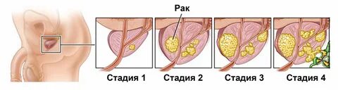 Рак простаты выздоровления