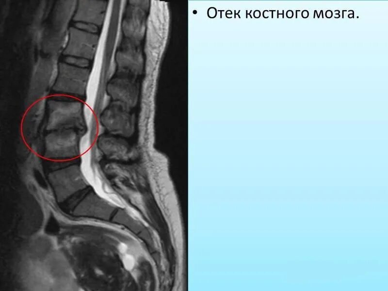 Участки отека костного мозга