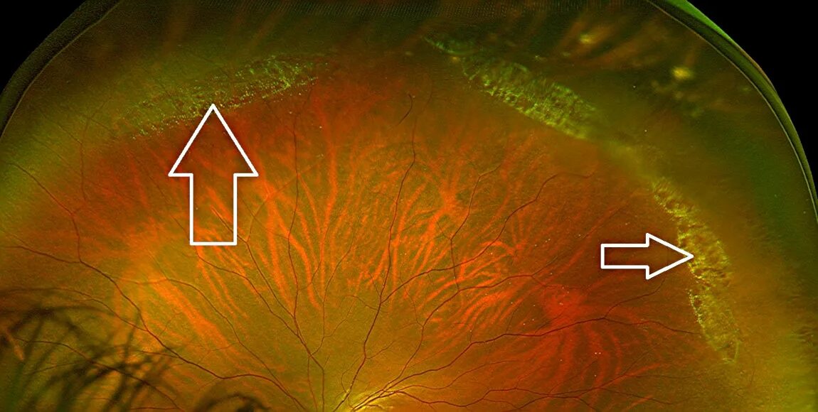 Периферические ретинальные дегенерации. Дистрофия сетчатки след улитки. Инеевидная дегенерация сетчатки. Инееподобная дистрофия сетчатки.