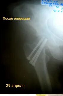 Прогнозы после операции перелома шейки