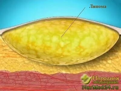Доброкачественное новообразование жировой ткани кожи