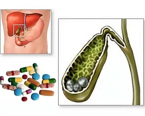 Приступы желчного пузыря при камнях. Камни из желчного пузыря.