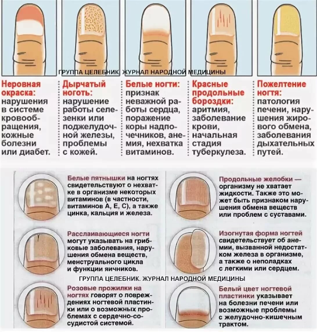 Что означают белые пятна на ногтях рук. Диагностика по ногтям. Типы и формы ногтевых пластин. Выявление болезни по ногтям.