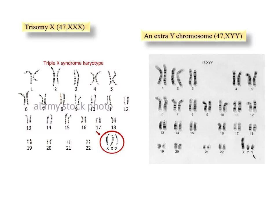 Трипло х. Трисомия Шерешевского-Тернера трисомия. Хромосомный набор человека. Трисомия XYY.