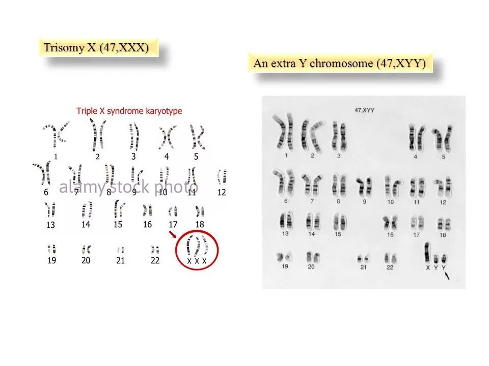 Трисомия Шерешевского-Тернера трисомия. Хромосомный набор человека. Трисомия XYY.