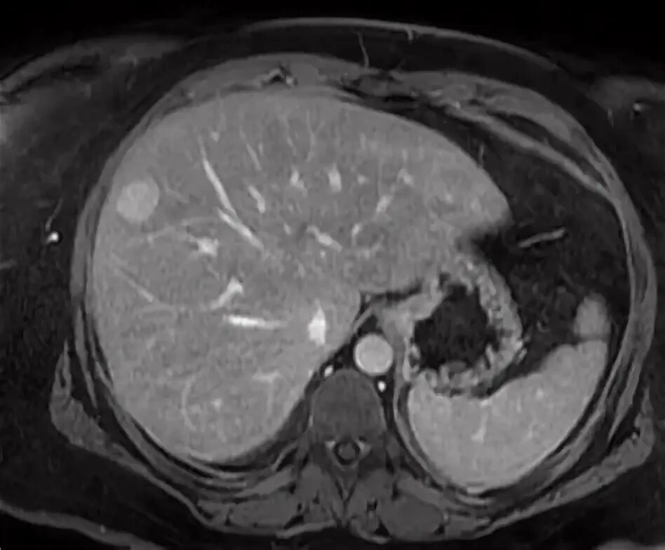 Hepatocellular Carcinoma and Variants Basicmedical Key