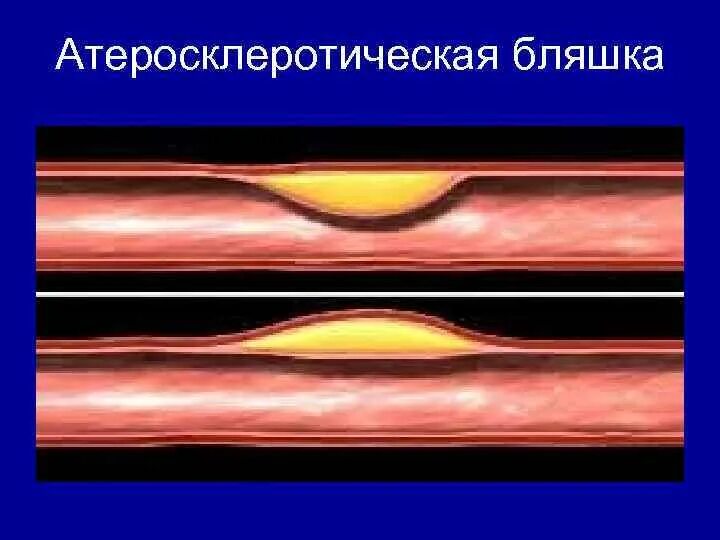 Атеросклеротические атеросклеротические поражения конечностей. Циркулярная атеросклеротическая бляшка. Экранирующая атеросклеротическая бляшка. Фиброзная атеросклеротическая бляшка 1,6 им. Пролонгированная атеросклеротическая бляшка – это.