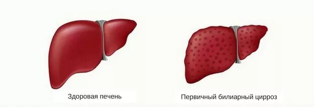 Циррозе печени статья. Билиарный цирроз печени патанатомия. гипертрофический цирроз печени. первичный цирроз печени. первичный билиарный цирроз печени симптомы.