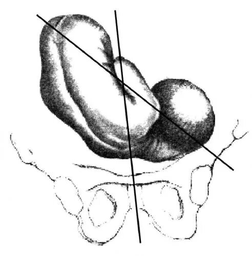 Головное предлежание 2. Поперечное и косое положение плода. Поперечное предлежание плода. Предлежание плода косое положение. Поперечное и косое положение плода предлежание.