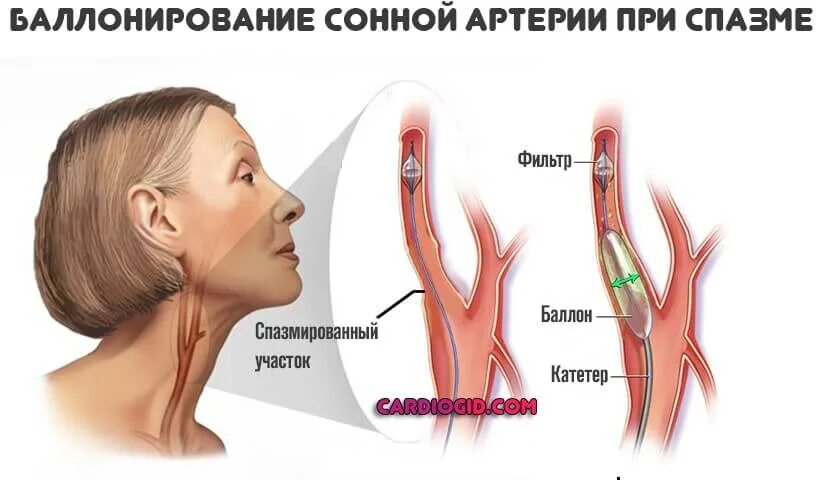 Бляшка на шее операция. Каротидная артерия.