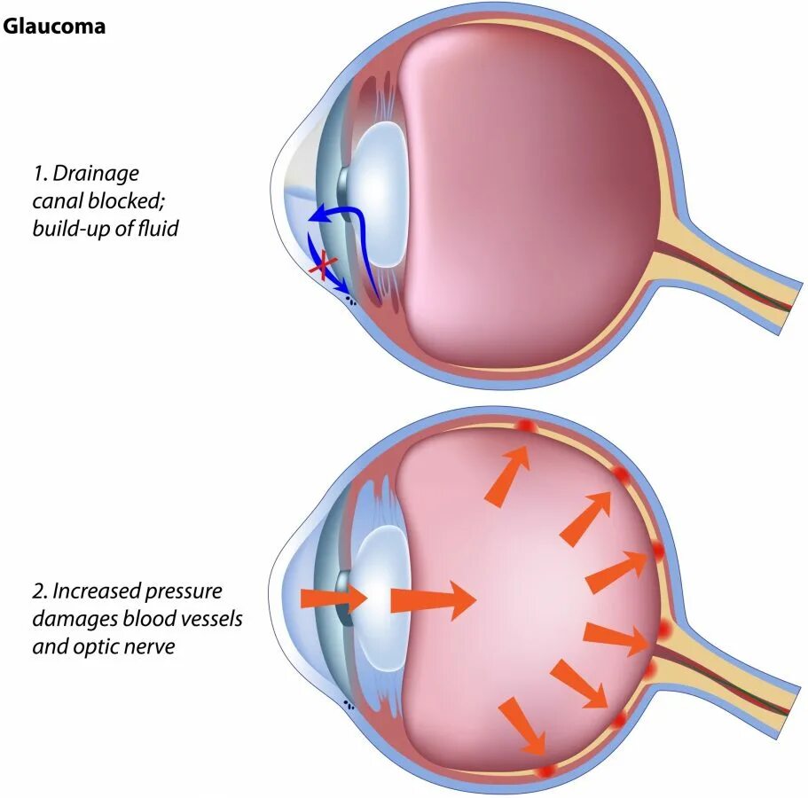 Глаукома глаза причины. Первичная открытая глаукома.