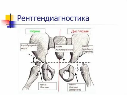 Нормы ацетабулярного угла у детей