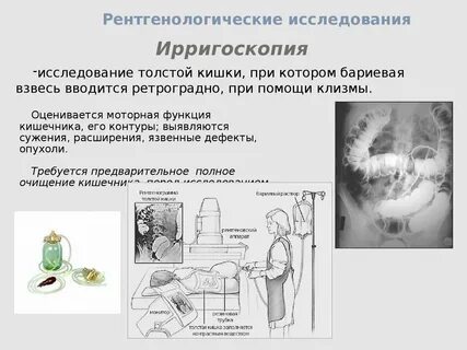 Ирригоскопия кишечника подготовка к исследованию