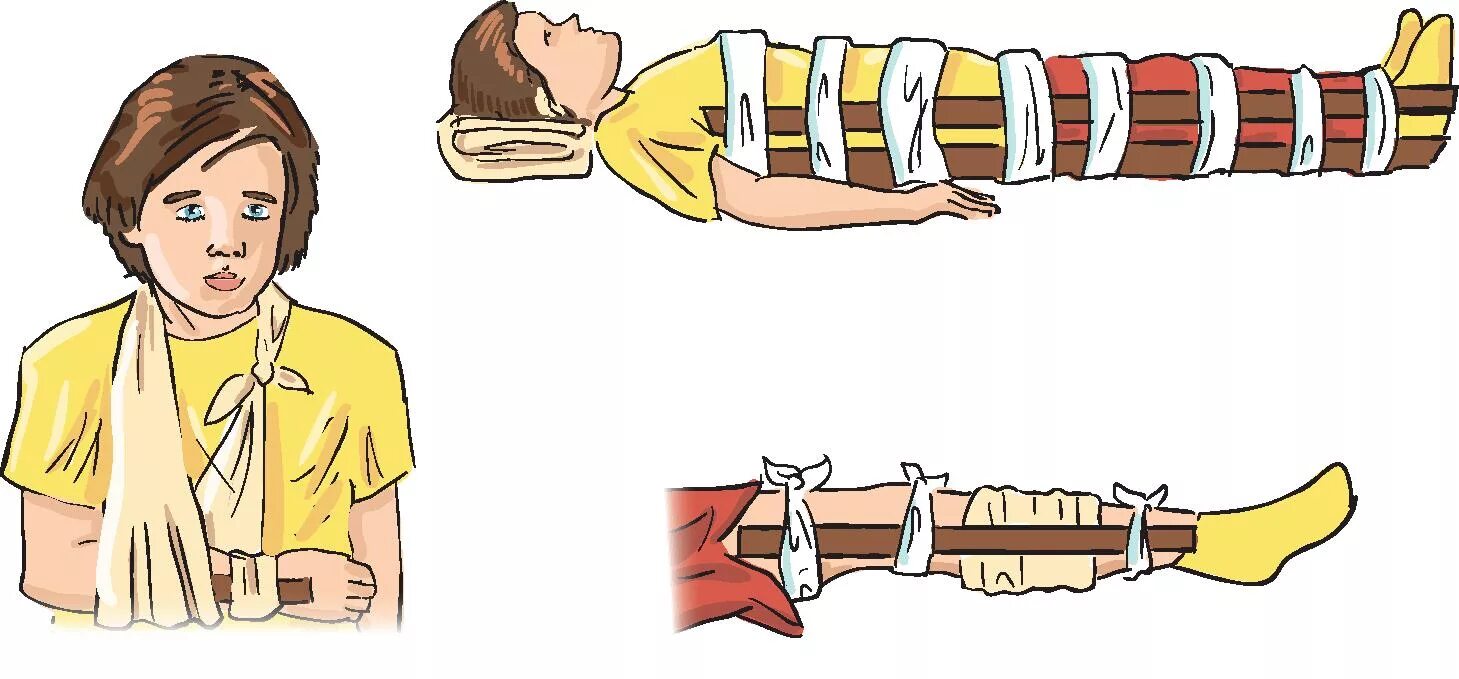 При открытом переломе перед наложением шины. Иммобилизация при открытом переломе. Иммобилизация конечности при переломе. Мобилизация конечности при переллмах. Иммобилизация конечностей при закрытом переломе.