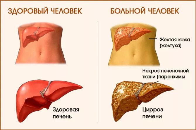 Почему печень желтая. Циррозов печени симптоматология. Токсический цирроз печени симптомы. Токсическое поражение печени цирроз.