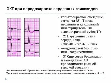 Интоксикация на экг