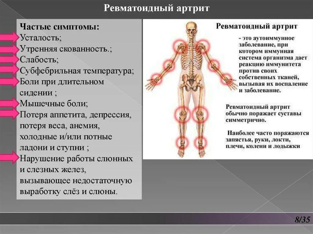 Симптомы поражения суставов ревматоидного артрита. Суставные поражения при ревматоидном артрите. Что поражается при ревматоидном артрите. При ревматоидном артрите поражаются суставы. Ревматоидный артрит мышцы