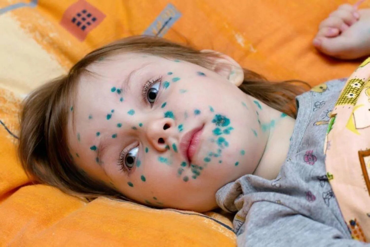 чем прижигать ветрянку у детей