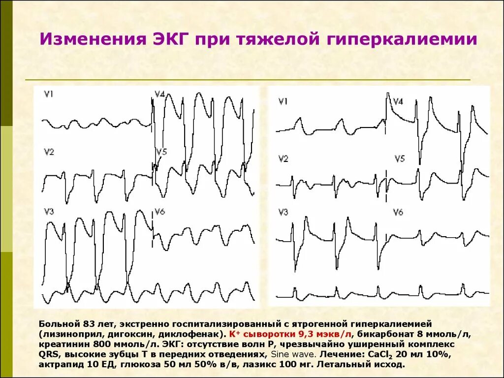 ЭКГ признаки гиперкалиемии ЭКГ. Гипокалиемия и гиперкалиемия на ЭКГ. Гиперкалиемия на ЭКГ характеризуется. Проявления гиперкалиемии на ЭКГ. Тяжелое экг