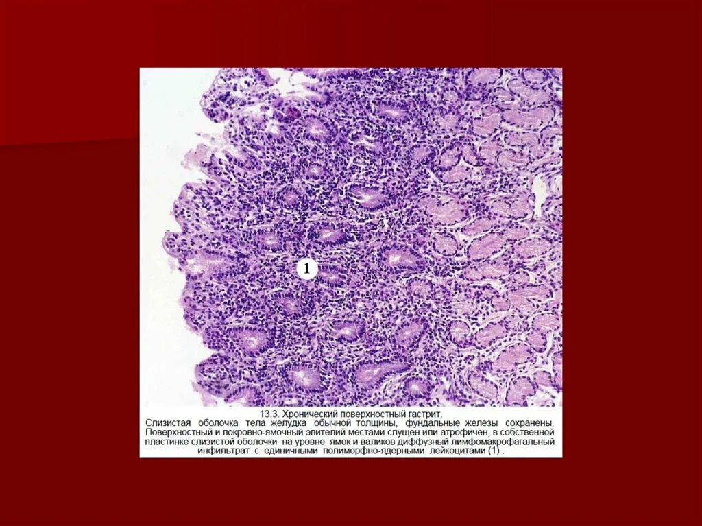 Некротический гастрит патанатомия. Поверхностный гастрит гистология. Хронический гастрит микропрепарат патанатомия. Фибринозный гастрит макропрепарат.