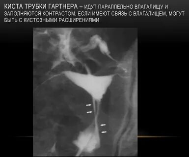 Парауретральная железа у женщин