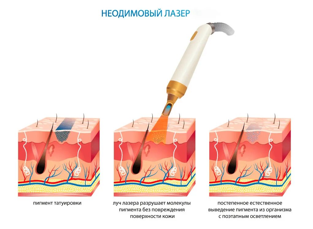 Как происходит лазерная
