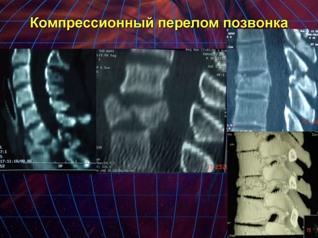 Лечение последствия компрессионного перелома позвоночника. Компрессионный перелом позвоночника тн6. Компрессионный перелом л3 л4. Компрессионный перелом тел c5 c6. Компрессионный перелом позвонка т6.