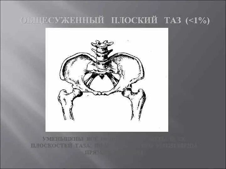 Охарактеризуйте простой плоский таз. Простой плоский таз. Плоский таз. Простой плоский таз девентеровский. Суженный плоскорахитический таз.