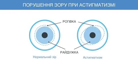 Зрение астигматизм как видит человек