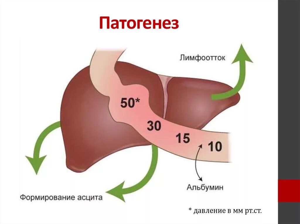 Гипертонии печень. Механизм развития портальной гипертензии при циррозе печени. Портальная гипертензия патогенез схема. Механизм развития асцита при портальной гипертензии. Синдром портальной гипертензии патогенез.
