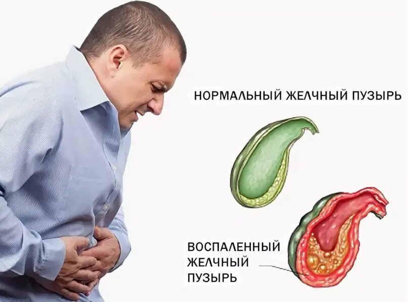 Как лечить желчный пузырь у мужчин