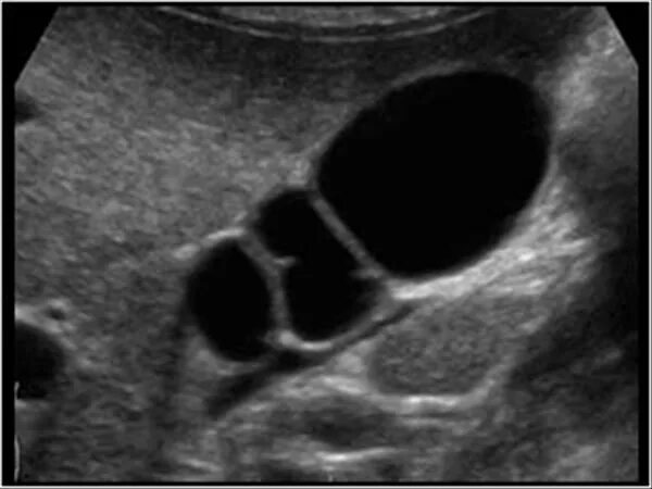 Мукоцеле желчного пузыря. Мукоцеле аппендикса на УЗИ. Мукоцеле желчного пузыря УЗИ. Мукоцеле желчного пузыря у собак УЗИ.