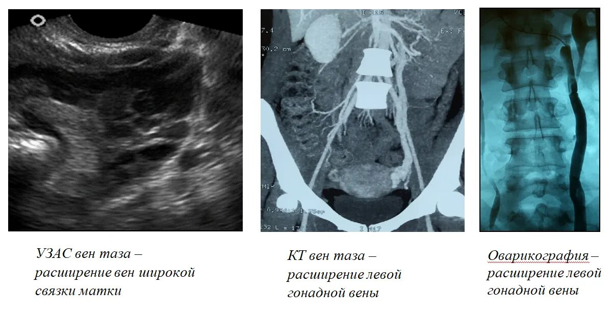 Варикоз малого таза причины. Варикозное расширение вен малого таза по УЗИ. Варикозное расширение вен малого таза 1 степени. Варикозное расширение вен малого таза мрт. Тромбоз вен малого таза.
